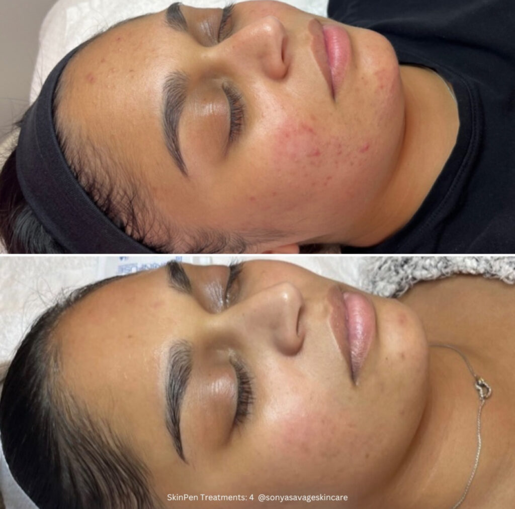 Acne treatment by SkinPen Microneedling | Meraki Wellness & Med Spa | FL