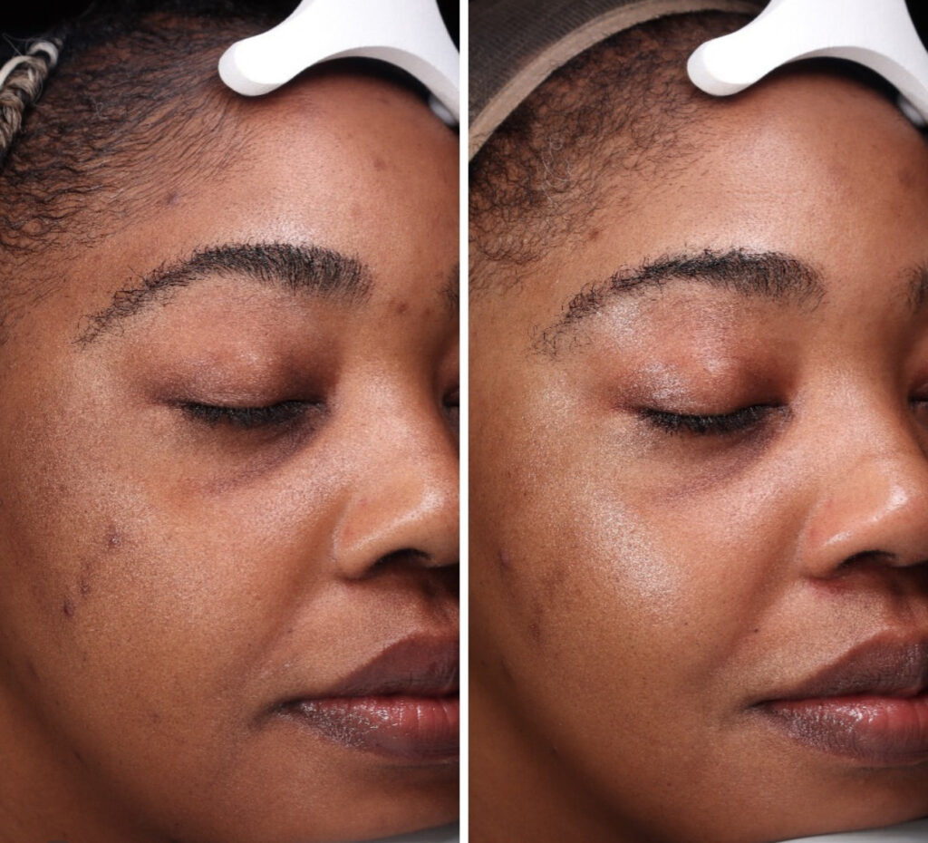 SkinPen Microneedling before and after photo | Meraki Wellness & Med Spa | FL