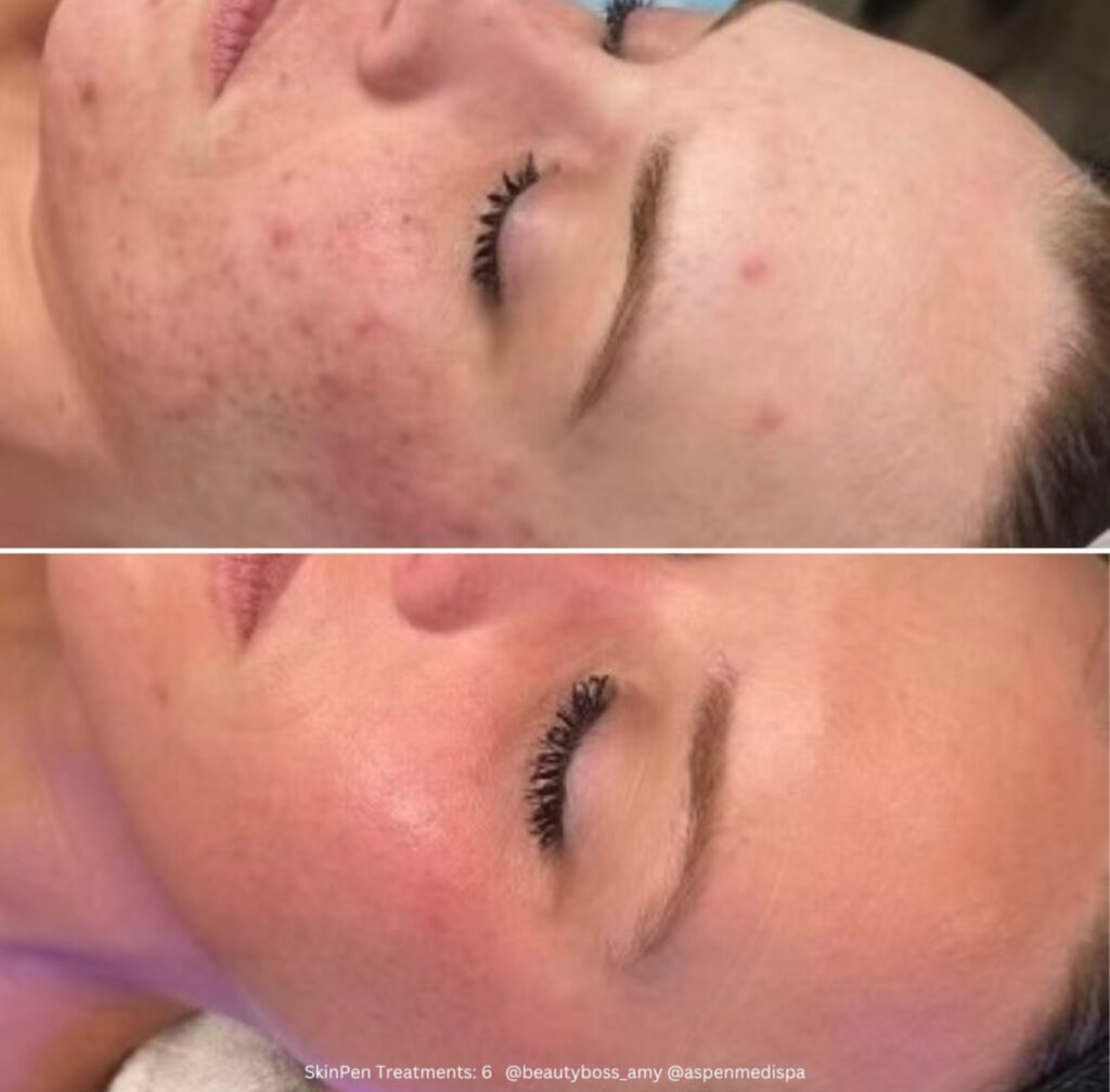 Acne marks treatment | before and after | Meraki Wellness & Med Spa | FL