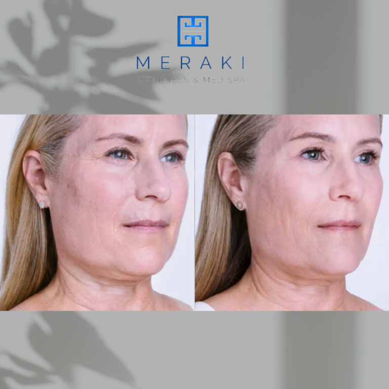 Ultherapy Face Lift | before and after | Meraki Wellness & Med Spa | FL