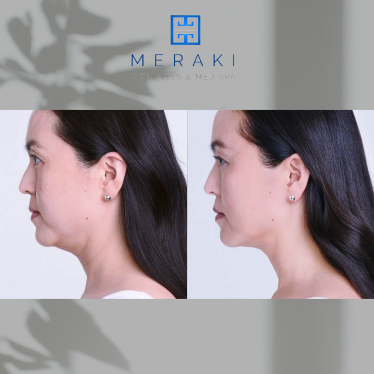 Ultherapy chin lift | before and after | Meraki Wellness & Med Spa | FL