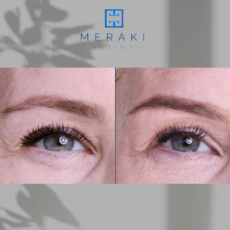 Ultherapy Eye Lift | before and after | Meraki Wellness & Med Spa | FL