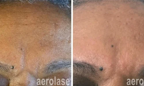 a close up of a person's pigmented forehead | before and after photo | Meraki Wellness & Med Spa | Altamonte Springs, FL