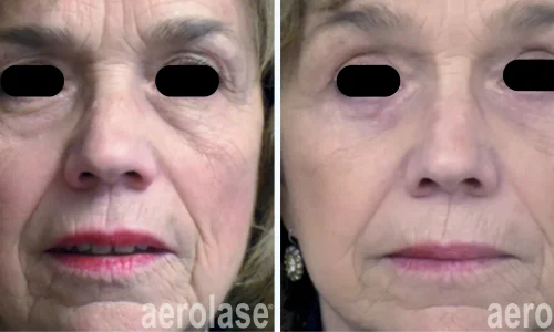 Aging skin treatment | before and after photo | Meraki Wellness & Med Spa | Altamonte Springs, FL