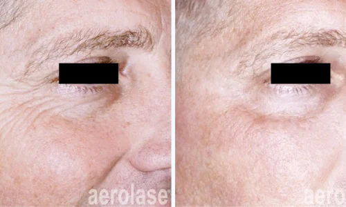 Wrinkles reduction by Aerolase | before and after photo | Meraki Wellness & Med Spa | Altamonte Springs, FL