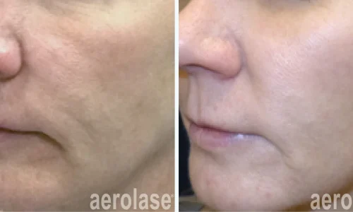 Aerolase laser for skin smoothness | before and after photo | Meraki Wellness & Med Spa | Altamonte Springs, FL