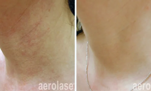 Hyperpigmentation treatment by Aerolase Laser for skin | before and after photo | Meraki Wellness & Med Spa | Altamonte Springs, FL