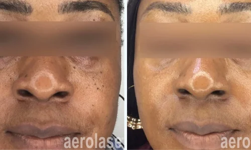 Aerolase for skin | before and after photo | Meraki Wellness & Med Spa | Altamonte Springs, FL