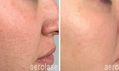 Aerolase Laser for hyperpigmentation treatment | before and after photo | Meraki Wellness & Med Spa | Altamonte Springs, FL