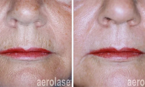 Fine lines treatment by Aerolase Laser | before and after photo | Meraki Wellness & Med Spa | Altamonte Springs, FL