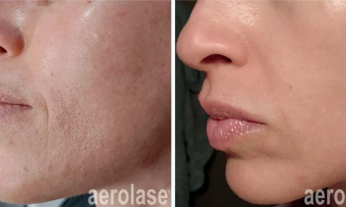 Aerolase for fine lines | before and after photo | Meraki Wellness & Med Spa | Altamonte Springs, FL