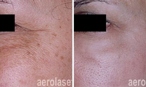 Aerolase Laser for pigmentation | before and after photo | Meraki Wellness & Med Spa | Altamonte Springs, FL