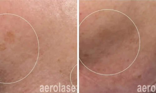 a close up of a pigmented skin | before and after photo | Meraki Wellness & Med Spa | Altamonte Springs, FL