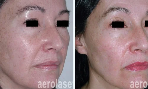 Aerolase for pigmentation on face | before and after photo | Meraki Wellness & Med Spa | Altamonte Springs, FL