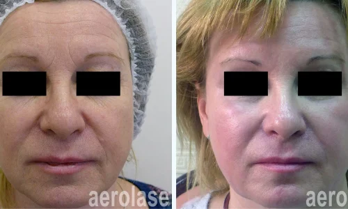 Aerolase Laser for wrinkles | before and after photo | Meraki Wellness & Med Spa | Altamonte Springs, FL