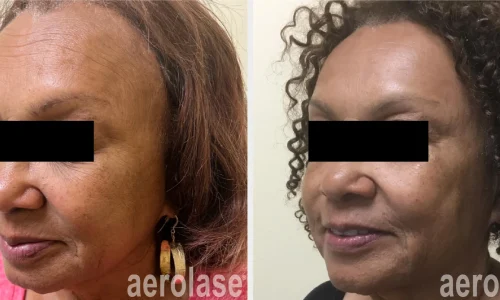 Aerolase for wrinkles | before and after photo | Meraki Wellness & Med Spa | Altamonte Springs, FL