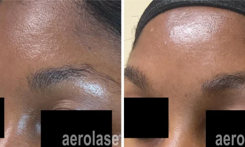 Aerolase Laser for forehead | before and after photo | Meraki Wellness & Med Spa | Altamonte Springs, FL