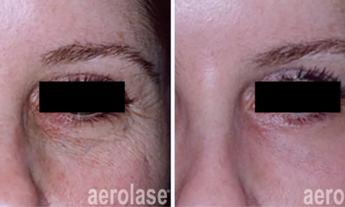 close-up of a wrinkles under eyes | before and after photo | Meraki Wellness & Med Spa | Altamonte Springs, FL