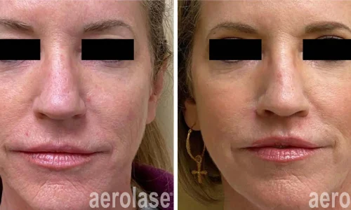 Aging skin treatment by Aerolase Laser | before and after photo | Meraki Wellness & Med Spa | Altamonte Springs, FL