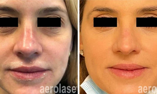 Aerolase for aging skin | before and after photo | Meraki Wellness & Med Spa | Altamonte Springs, FL