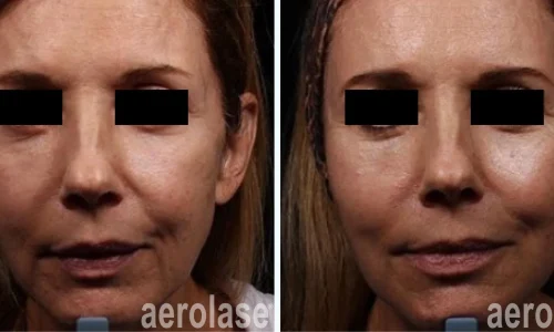 Aerolase for dull skin | before and after photo | Meraki Wellness & Med Spa | Altamonte Springs, FL