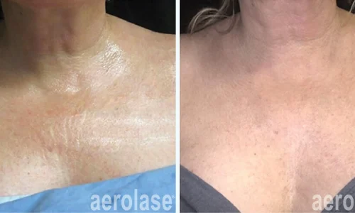 Aging skin treatment | Aerolase Laser | before and after photo | Meraki Wellness & Med Spa | Altamonte Springs, FL