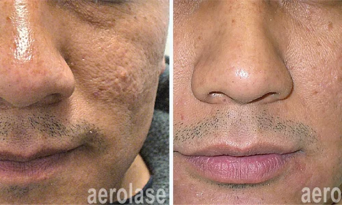 Acne and scars reduction | before and after photo | Meraki Wellness & Med Spa | Altamonte Springs, FL