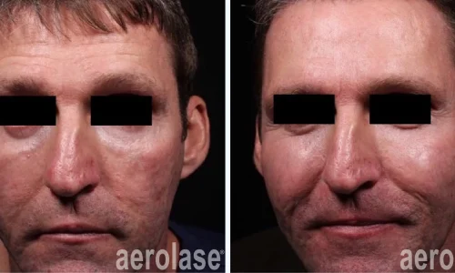 Aging skin treatment using Aerolase Laser | before and after photo | Meraki Wellness & Med Spa | Altamonte Springs, FL