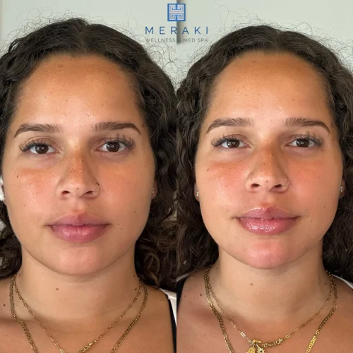 Women before and after chin and jawline | Meraki Wellness & Med Spa | Altamonte Springs, FL