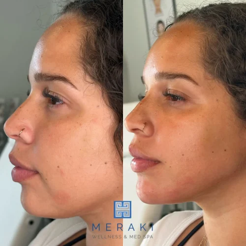 Women before and after chin and jawline | Meraki Wellness & Med Spa | Altamonte Springs, FL