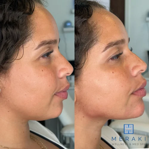 Women before and after chin and jawline | Meraki Wellness & Med Spa | Altamonte Springs, FL