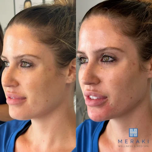 Women before and after chin and jawline | Meraki Wellness & Med Spa | Altamonte Springs, FL