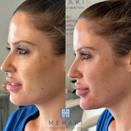 Women before and after chin and jawline | Meraki Wellness & Med Spa | Altamonte Springs, FL