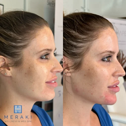 Women before and after chin and jawline | Meraki Wellness & Med Spa | Altamonte Springs, FL