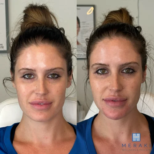 Women before and after chin and jawline | Meraki Wellness & Med Spa | Altamonte Springs, FL