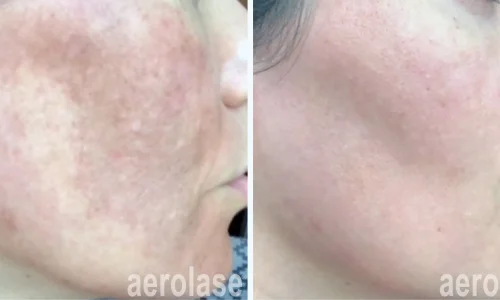 Hyperpigmentation by Aerolase | before and after photo | Meraki Wellness & Med Spa | Altamonte Springs, FL