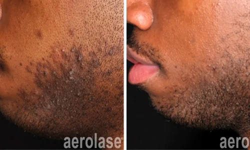 Hyperpigmentation in chin area | Aerolase | before and after photo | Meraki Wellness & Med Spa | Altamonte Springs, FL