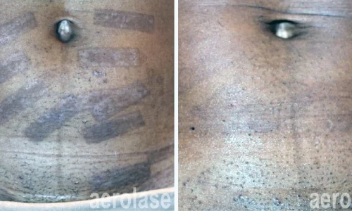 Pigmentation under naval area | before and after photo | Meraki Wellness & Med Spa | Altamonte Springs, FL