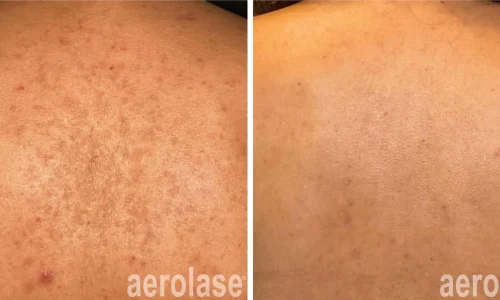 Hyperpigmentation in back | Aerolase Laser | before and after photo | Meraki Wellness & Med Spa | Altamonte Springs, FL