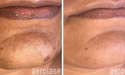 Pigmentation in chin area | before and after photo | Meraki Wellness & Med Spa | Altamonte Springs, FL