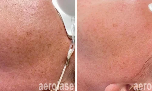 Close up of pigmented skin | before and after photo | Meraki Wellness & Med Spa | Altamonte Springs, FL