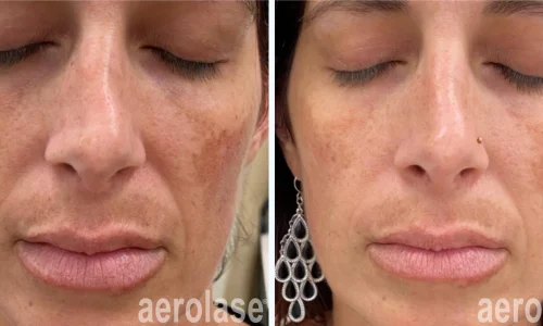 a woman having hyperpigmentation | before and after photo | Meraki Wellness & Med Spa | Altamonte Springs, FL