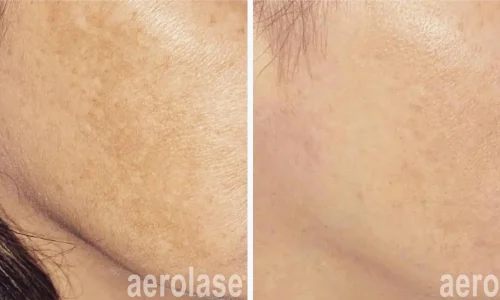 close up of a person's hyperpigmentation skin | before and after photo | Meraki Wellness & Med Spa | Altamonte Springs, FL