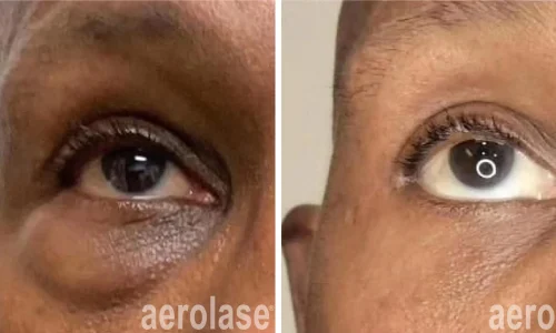 Hyperpigmentation under eye | Aerolase laser | before and after photo | Meraki Wellness & Med Spa | Altamonte Springs, FL