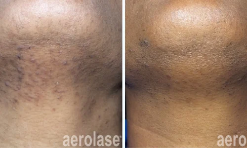 Hyperpigmentation treatment by Aerolase Laser | before and after photo | Meraki Wellness & Med Spa | Altamonte Springs, FL