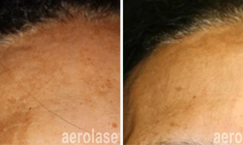 Hyperpigmentation treatment by Aerolase Laser | before and after photo | Meraki Wellness & Med Spa | Altamonte Springs, FL