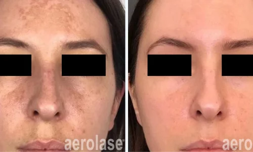 Aerolase for hyperpigmentation | before and after photo | Meraki Wellness & Med Spa | Altamonte Springs, FL