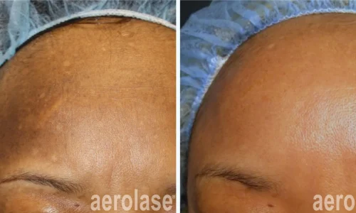 Hyperpigmentation on forehead | before and after photo | Meraki Wellness & Med Spa | Altamonte Springs, FL