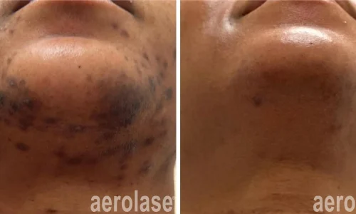 Hyperpigmentation | before and after photo | Meraki Wellness & Med Spa | Altamonte Springs, FL