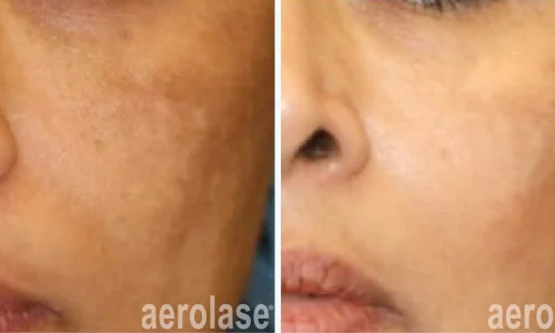 Pigmented cheek | before and after photo | Meraki Wellness & Med Spa | Altamonte Springs, FL